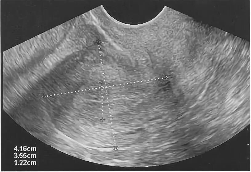 Что значит матки диффузный. Измерение толщины эндометрия на УЗИ. Эндометрий миометрий на УЗИ. Толщина миометрия на УЗИ.