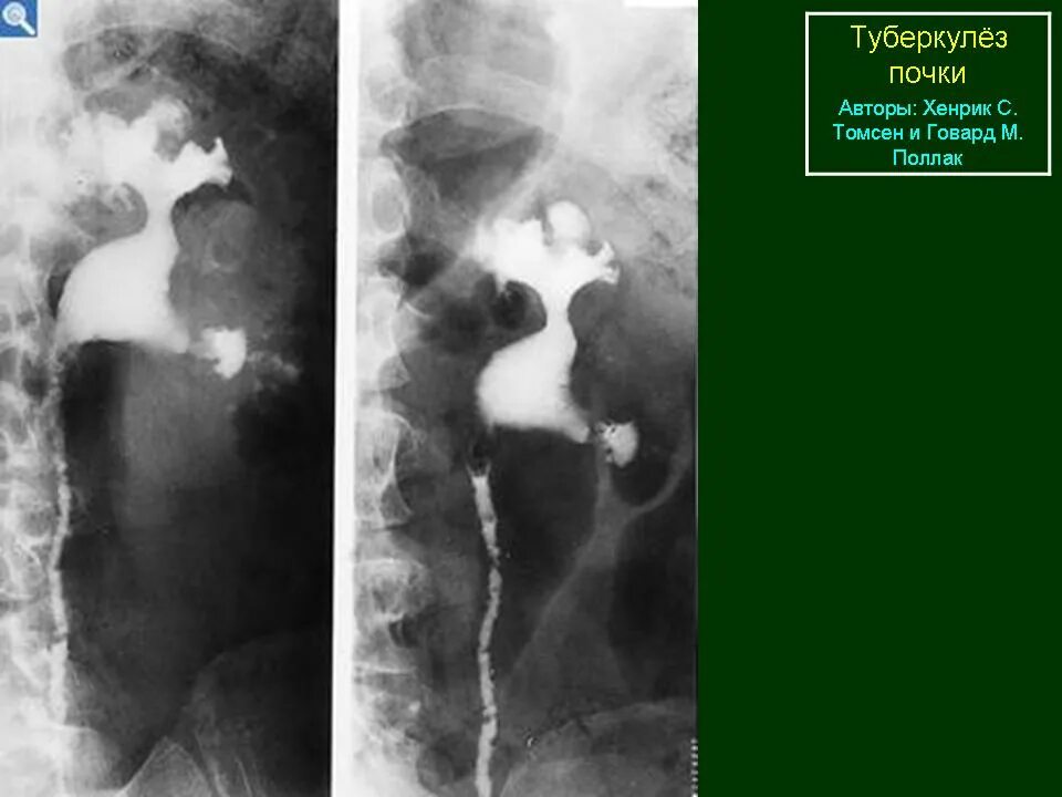 Туберкулез мочевой системы. Туберкулез почки урография. Экскреторная урография туберкулез почек. Туберкулез мочевого пузыря кт. Туберкулез мочевого пузыря рентген.