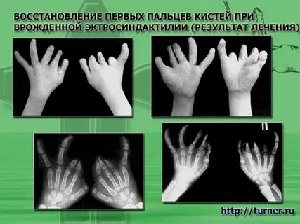 Восстановление пальцев