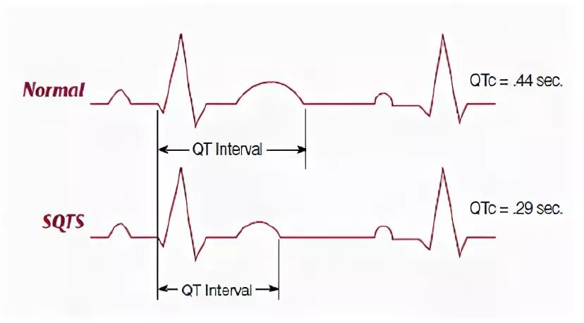 Удлиненное qt на экг. Синдром короткого qt на ЭКГ. Синдром укороченного qt на ЭКГ. Укороченный интервал qt на ЭКГ. Синдром укороченного интервала qt на ЭКГ.