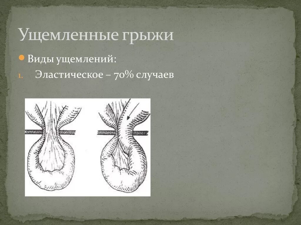 Ущемленная грыжа помощь. Эластическое ущемление грыжи.