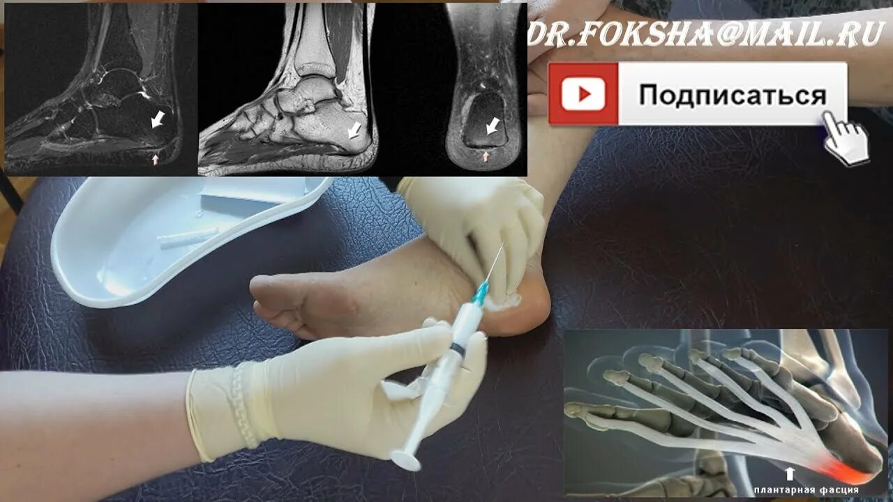 Дипроспан уколы в пятку при шпоре