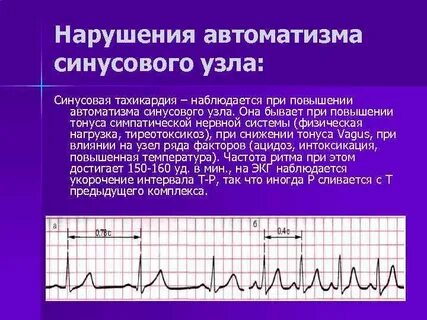 Нарушение автоматизма синусовая аритмия номотопный водитель
