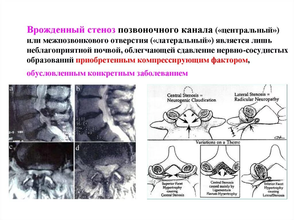 Поясничный абсолютный стеноз. Относительный Сагиттальный стеноз позвоночного канала с5-с7. Классификация дегенеративного стеноза позвоночного канала. Анатомическая узость костного позвоночного канала. Латеральный стеноз позвоночного канала на кт.