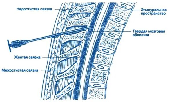 Эпидуральная спинная. Эпидуральная анестезия схема. Эпидуральная анестезия методика. Эпидуральная анестезия место пункции. Эпидуральная анестезия техника.