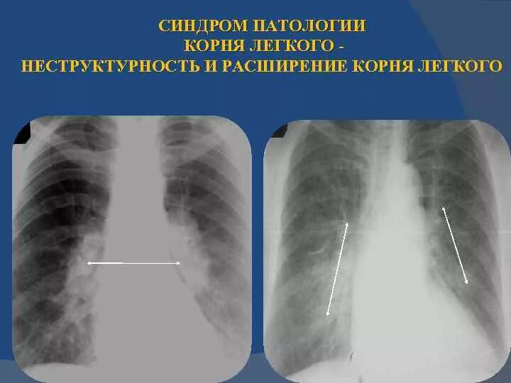 Увеличение корень легкого. Синдром патологии корня легкого. Синдром патологии корня легкого рентген. Расширение корня правого легкого рентген.