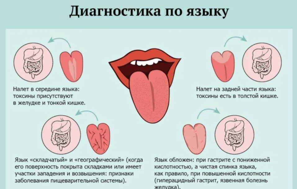 Как определить больной орган. Симптомы по цвету языка. Болезни по языку определить.