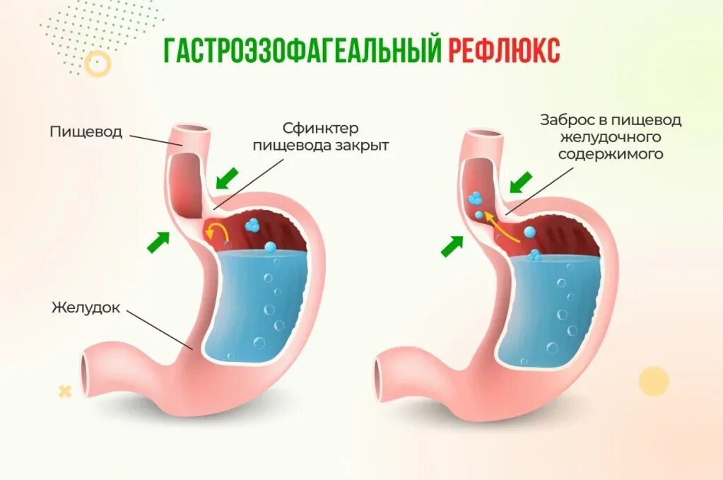 Изжога симптомы и лечение у взрослых. Изжога симптомы и лечение у взрослых