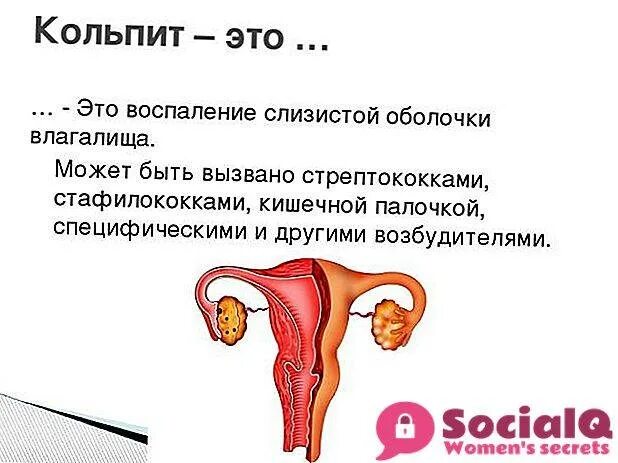 Кольпит при беременности 3 триместр. Воспаление слизистой оболочки кольпит. специфический кольпит.