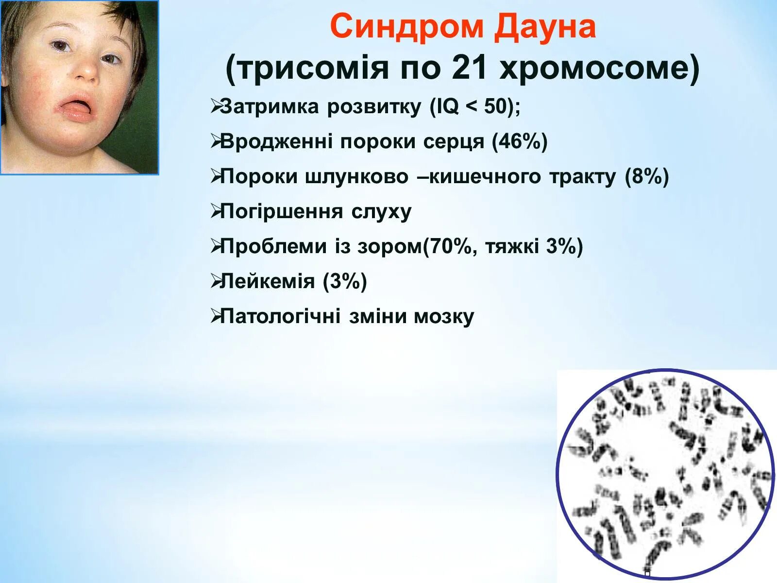 Синдром Дауна. Синдром Дауна хромосомы. Синдром Дауна трисомия. Синдром Дауна трисомия 21 хромосомы. Синдром дауна лишняя хромосома