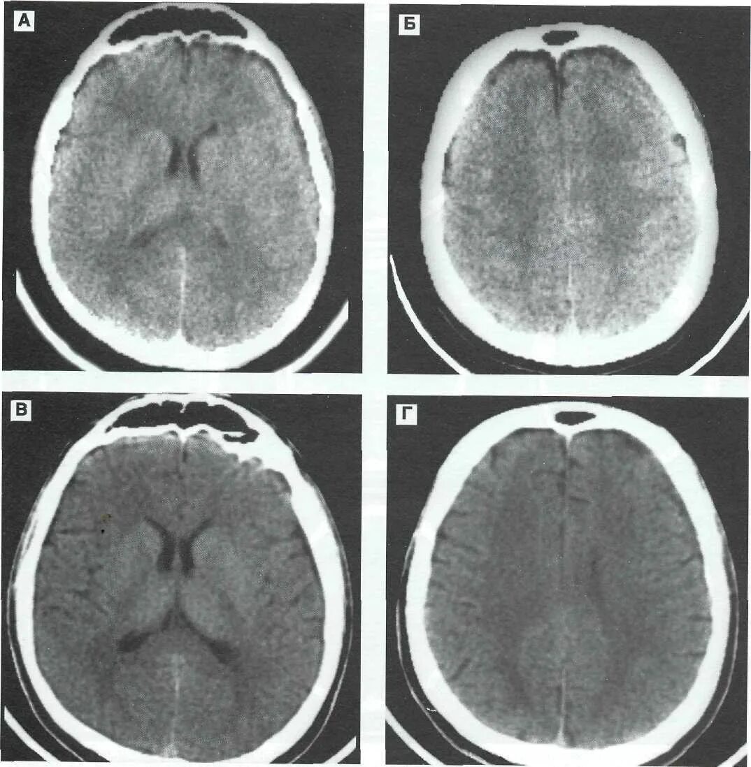 Аксональные повреждения головного мозга. Субарахноидальное кровоизлияние на кт межполушарной. Диффузное аксональное повреждение головного мозга кт. Аксональное повреждение головного мозга на кт. Диффузная травма мозга