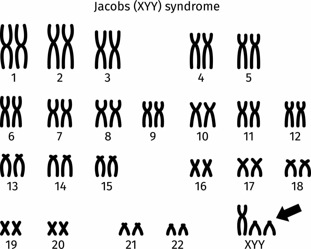 Xxy хромосома. 47 XYY кариотип. Синдром дисомии по у хромосоме кариотип. Klinefelter Syndrome karyotype. Дисомия по х хромосоме у мужчин кариотип.