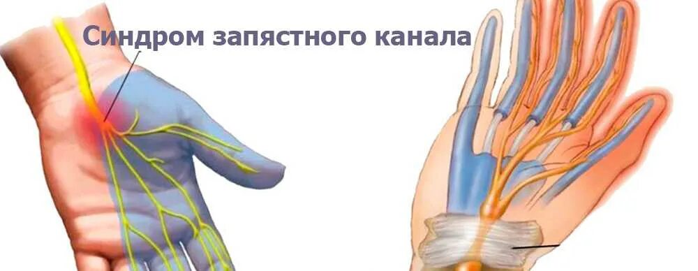После операции немеют пальцы рук. Карпальный туннельный синдром. запястный синдром синдром запястного канала. туннельный карпальный синдром руки. туннельный синдром запястья кисти руки.