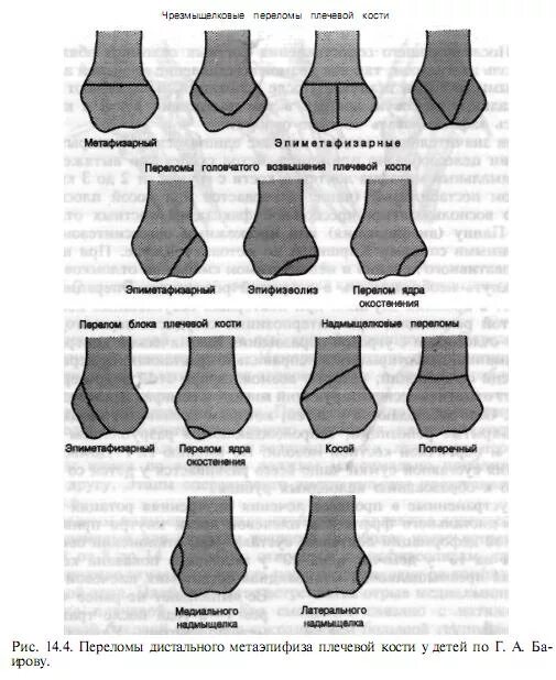 переломы дистального отдела плечевой кости. перелом дистального конца плечевой кости. чрезмыщелковый перелом локтевой кости. переломы дистального отдела плечевой кости. перелом дистальной части плечевой кости рентген.
