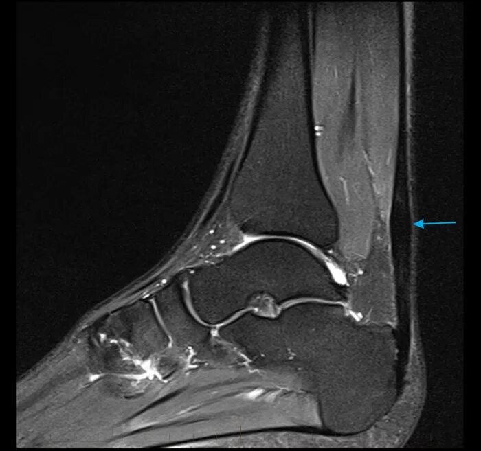 Мрт ахиллового сухожилия. Ахиллово сухожилие анатомия мрт. fhl tendon transfer for achilles tendon rupture.