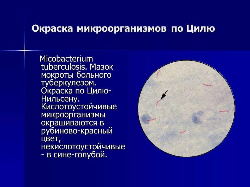 Мокрота окраска. Окраска бактерий по Цилю-Нильсену. Метод окраски бактерий по Цилю Нильсену. Метод микроскопии по Цилю-Нильсену это. Микроскопия по Цилю Нильсену туберкулез.