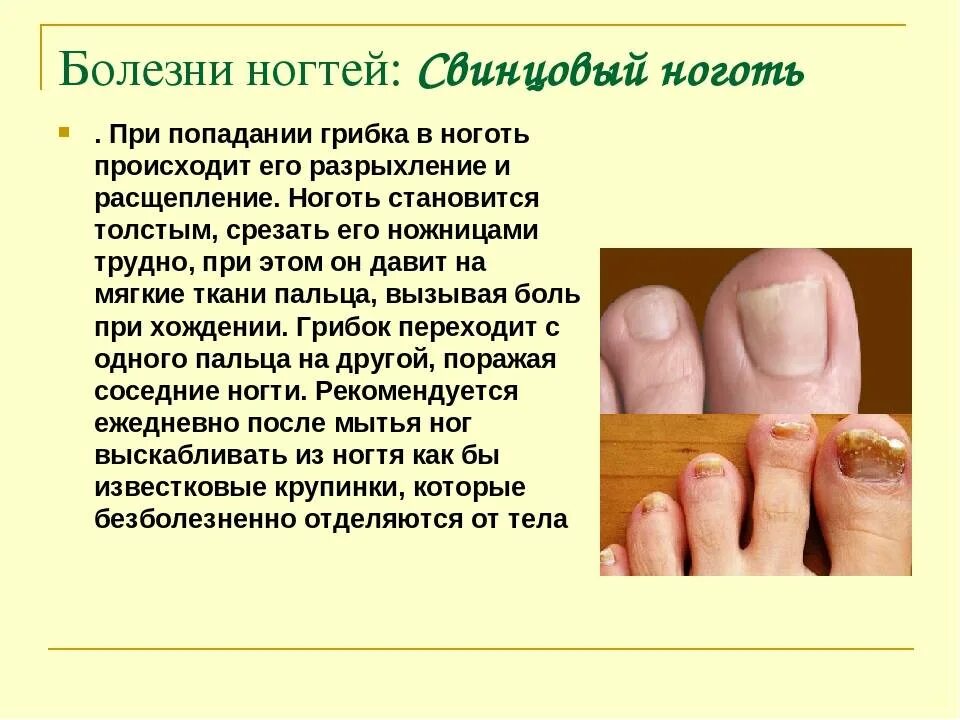 Соберите информацию о грибковых заболеваниях. Грибковые болезни ногтей. Грибковые заболевания ногтей рук.