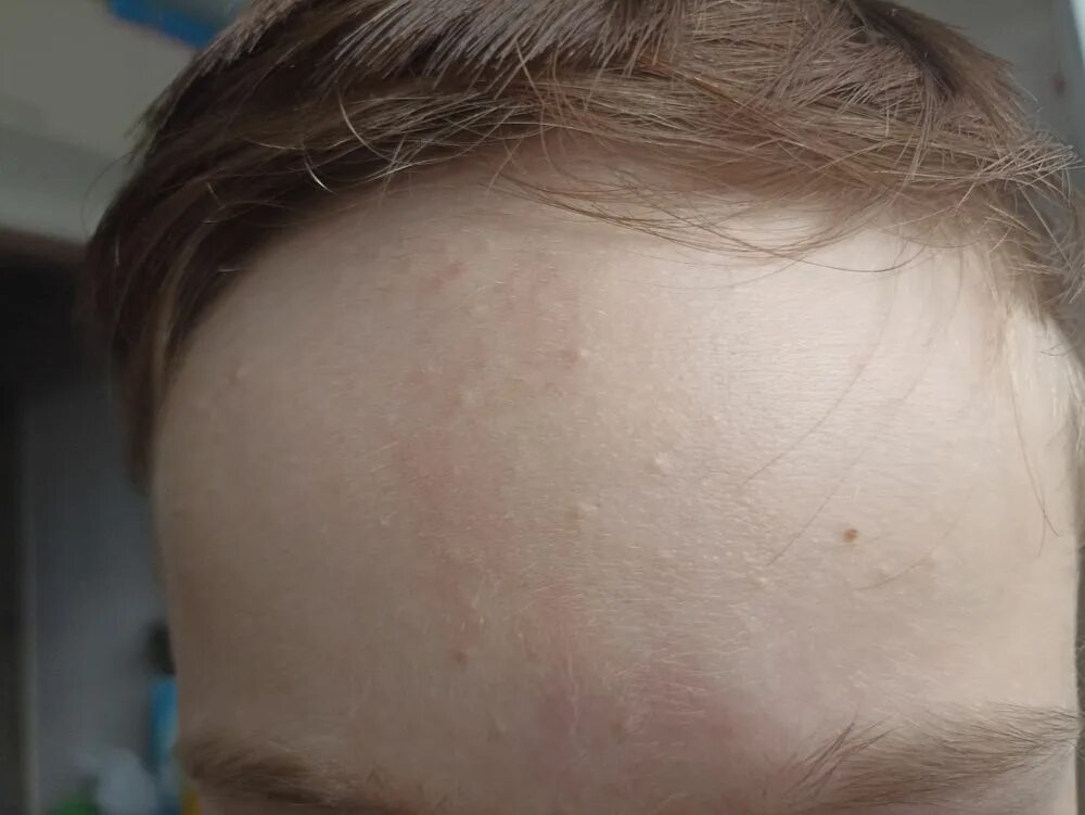 What are those white bumps on your face?