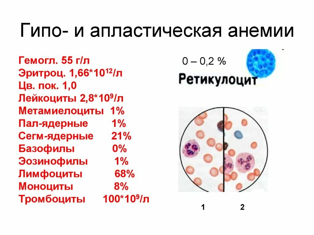 Картина крови гипопластической анемии. Картина периферической крови при гипо и апластических анемиях. Анализ крови при гипопластической анемии. Анализ крови при апластической анемии.