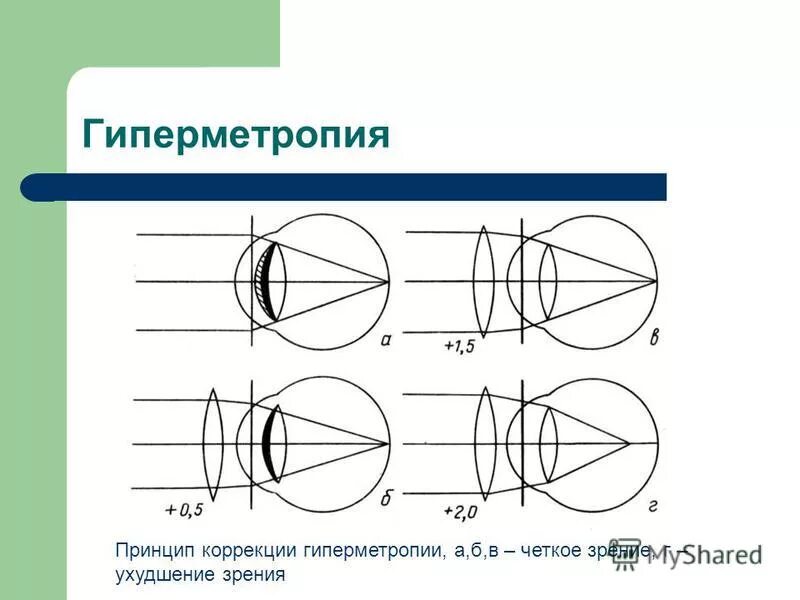 дефекты зрения ход лучей. фрк ласик. принципы коррекции аметропии. принцип коррекции зрения. принцип коррекции зрения.