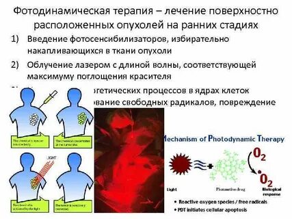 Фотодинамическая терапия отзывы