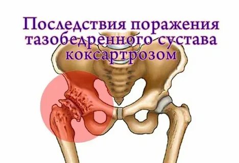 Где боли артроз тазобедренного сустава