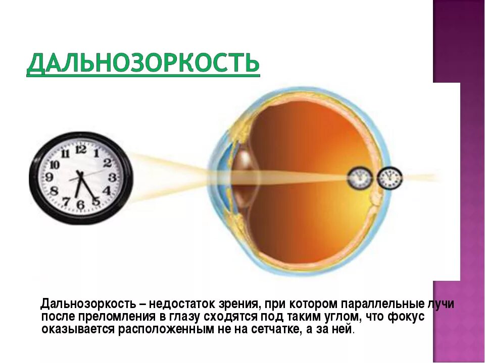 Недостатки дальнозоркости. Дальнозоркость. Дальнозоркость глаз. Зрение дальнозоркость. Глаз при дальнозоркости.