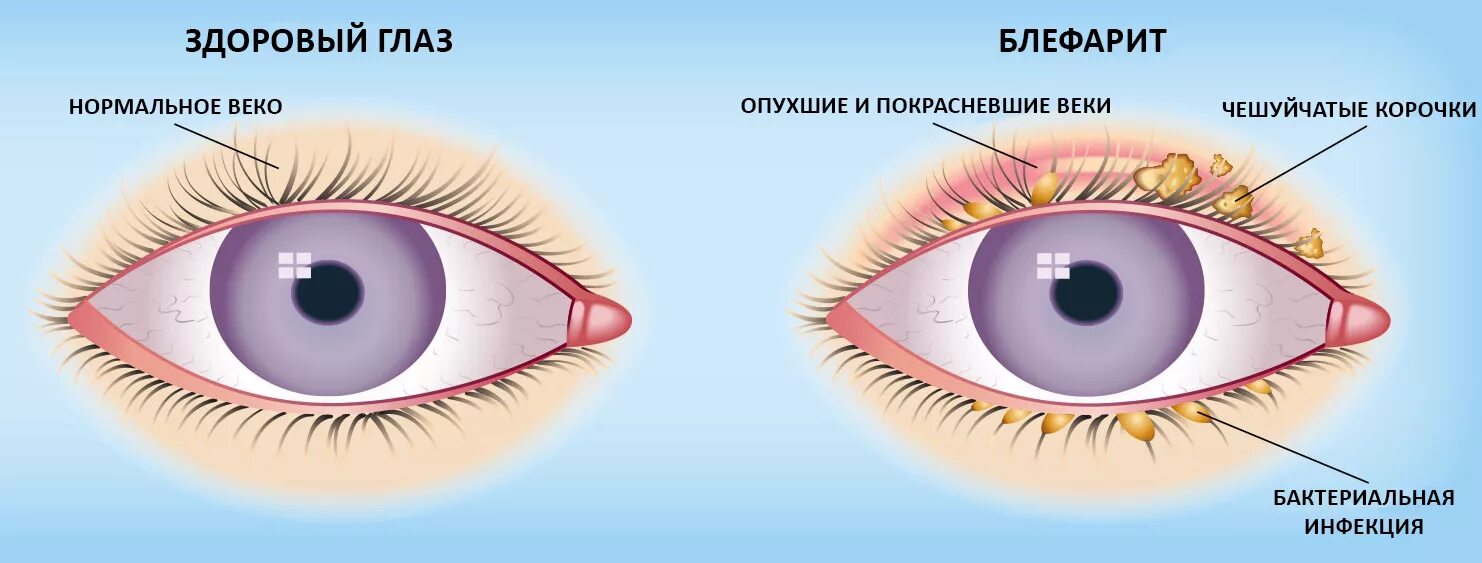 Веках почему е. Блефарит, конъюнктивит и кератит.. Блефарит конъюнктивит ячмень. Язвенный блефарит офтальмология.