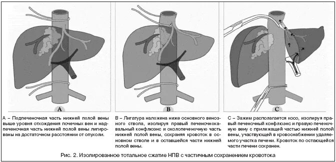 Операция по удалению печени. Эндопротезирование печеночных и нижней полой вен. Краевая резекция нижней полой вены. Краевая резекция печени. Операция нижней полой вены.