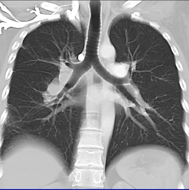 зубных протезов легких и бронхов кт. кт органов грудной клетки. мскт огк. мскт грудной клетки новосибирск. мрт органов грудной полости.