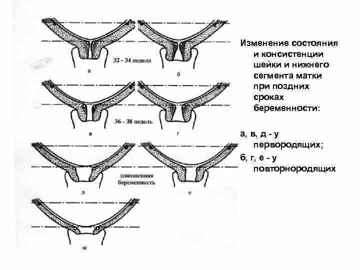 Изменение матки при беременности