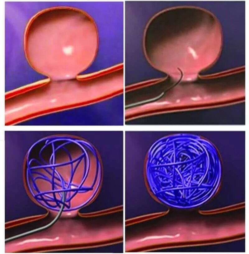 эндоваскулярная варикоцеле. эндоваскулярная эмболизация яичковой вены. варикоцеле — варикозное расширение вен яичка и семенного канатика. нижняя полая вена с кава фильтром. эмболизация вен при варикоцеле.