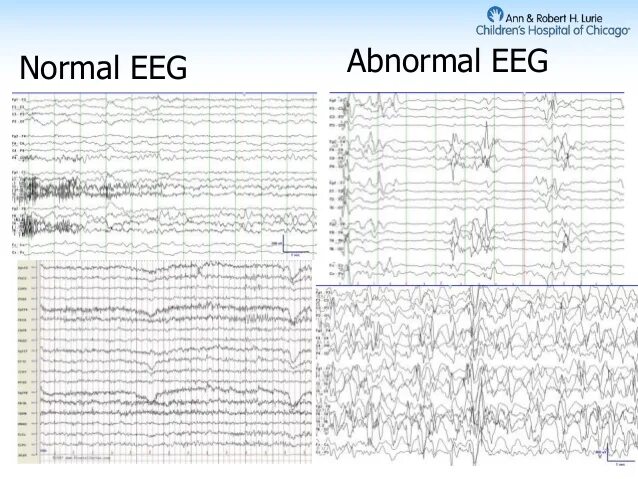 Normal abnormal. Normal eeg. delta brush eeg. diode eeg design. шапки eeg medicom.