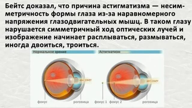 Когда восстанавливается зрение после замены хрусталика. Астигматизм ход лучей. Зрение при астигматизме. Астигматизм причины. Астигматизм упражнения для глаз.