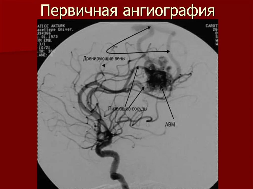 Мальформация сосудов. Артериовенозная мальформация ангиография. эмболизация авм сосудов головного мозга. мальформация селезеночной артерии. ангиография авм сосудов головного мозга.