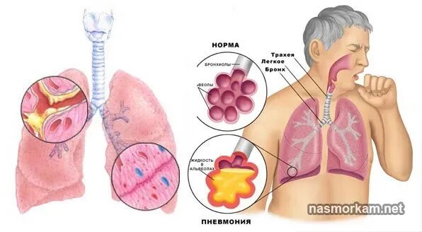 Большое отделение мокроты