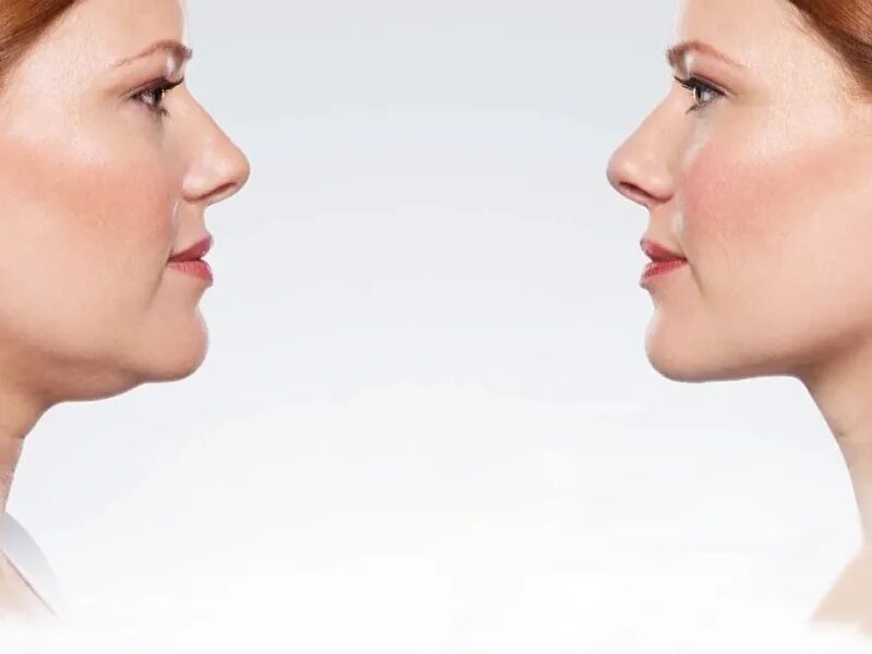 Женщина со вторым подбородком. Двойной подбородок. Двойной подбородок у женщин. Пятерной подбородок. Второй подбородок.