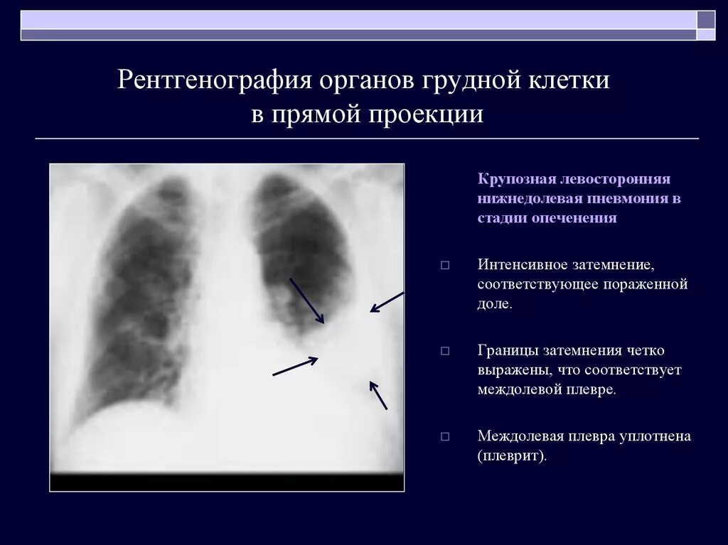 Остаточные после бронхита. Правосторонняя очаговая пневмония рентген. Крупозная пневмония стадии рентген. Крупозная пневмония рентген описание. Крупозная пневмония рентген признаки.