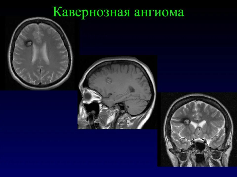 Ангиома головного мозга кт. Кавернозная гемангиома головного мозга кт. Кавернозная ангиома головного мозга кт. Ангиома правой лобной доли