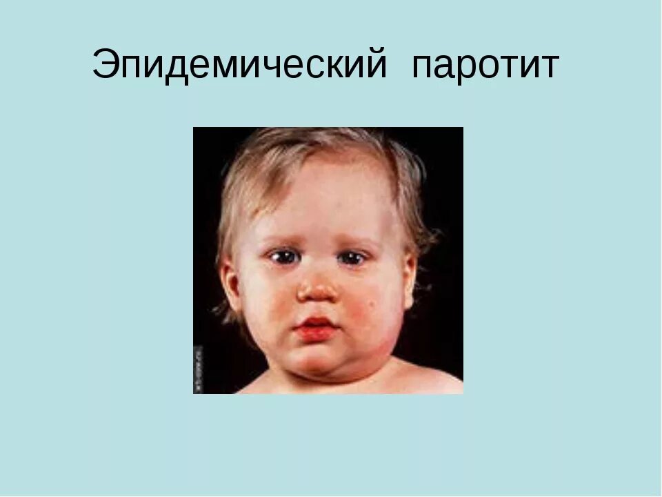 Паратит что это. Свинка эпидемический паротит. Эпидемический паротит Свинка симптомы. Свинка эпидемический паротит клиника. Эпидемический паротит слюнной железы.