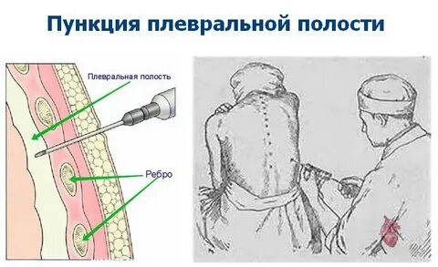Плевральная пункция