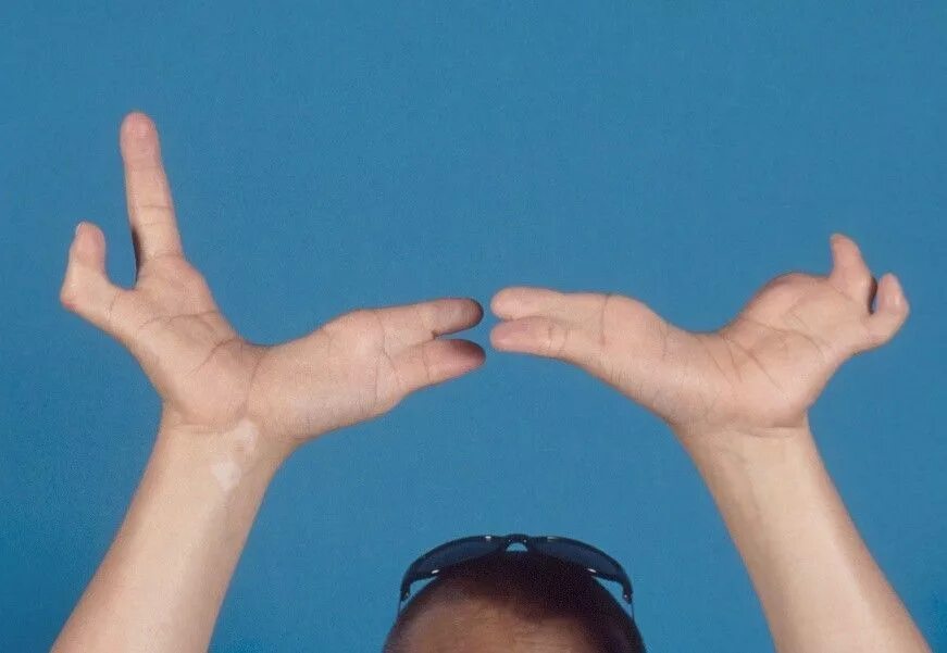 Четыре пальца на руке. Эктродактилия аномалия конечностей. Эктродактилия мутация. Пороки развития пальцев.