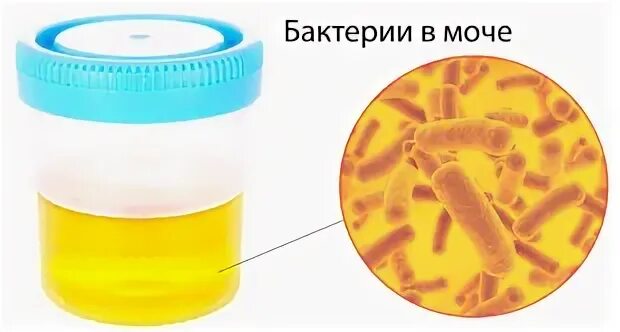 Высокие бактерии в моче. Бактериурия в моче. Бактерии в моче. Бактерии в моче у женщин. Бактерии в моче в моче.