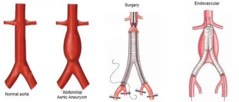 Abdominal aortic aneurysm