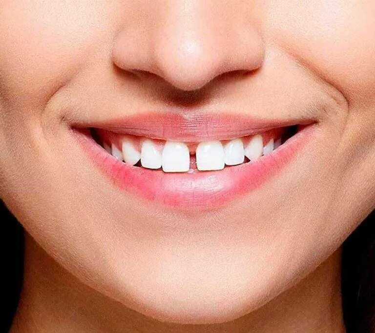 Аккуратнее зубы. Красивые зубы. Щель между передними зубами. Улыбка.