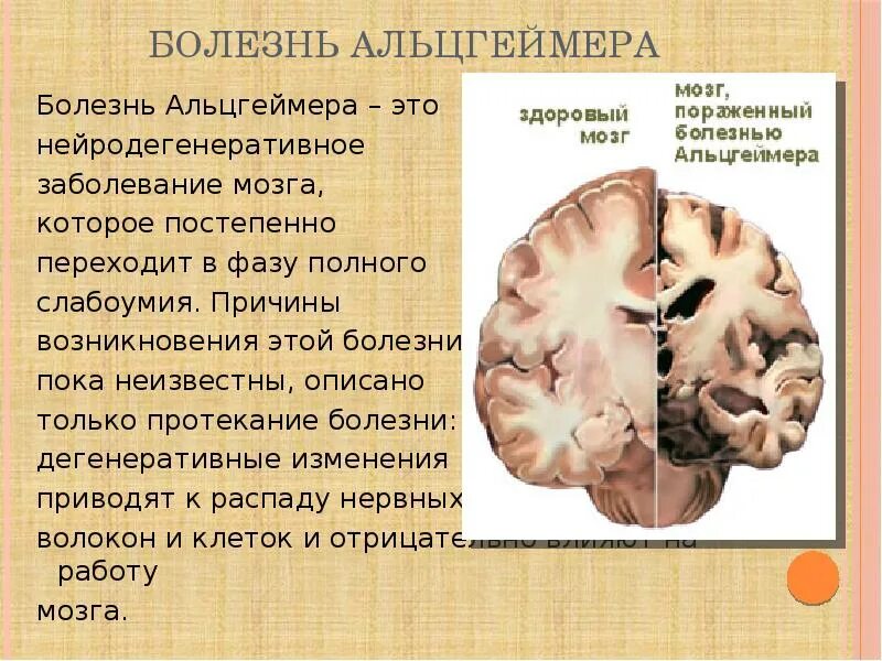 Поражение мозга болезнь. Болезнь Альцгеймера. Болезнь Альцгеймера головной мозг.