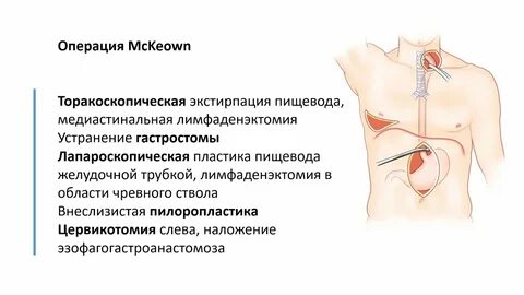 Опухоль пищевода операции