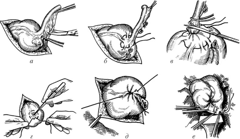 Этапы после операции. Антеградная и ретроградная аппендэктомия. Ретроградная аппендэктомия. Аппендэктомия этапы операции. Ретроградная аппендэктомия этапы операции.