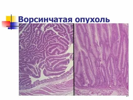 Полип low grade