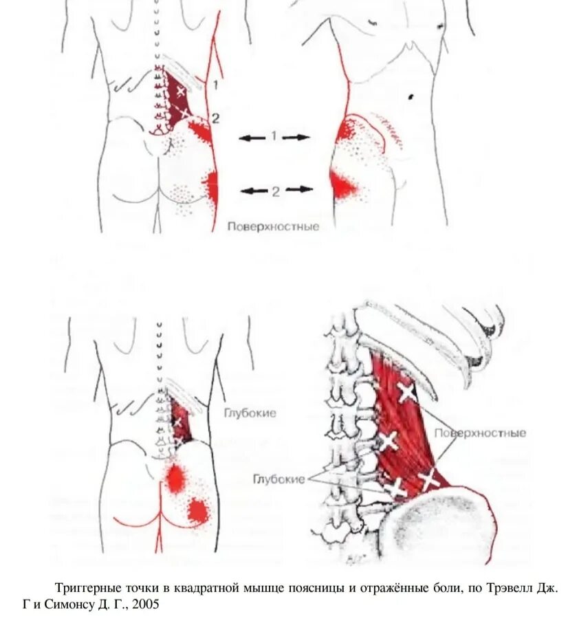 Точки на пояснице. Квадратная поясничная мышца триггерные точки. Триггерные точки мышц поясничного отдела.. Триггерные точки при болях в пояснице. Квадратная мышца спины триггерные точки.